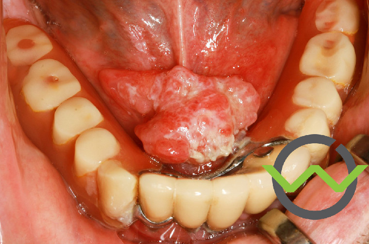 Ein Mundhöhlenkarzinom im Bereich des Mundbodens