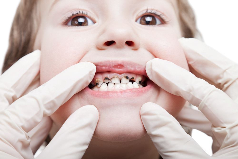 Kind mit kariösen Zähnen: Mit einer neuen Therapie könnten vielleicht komplette Zähne nachwachsen